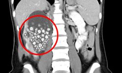 Tayvan'da kadının böbreklerinden bakın ne çıktı?