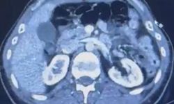 Ülkeye midelerinde uyuşturucu getiren şahıslar yakalandı!