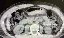 Midelerinde zehir sevkiyatı yapan 2 torbacı tutuklandı