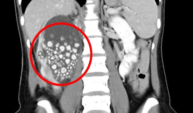Tayvan'da kadının böbreklerinden bakın ne çıktı?
