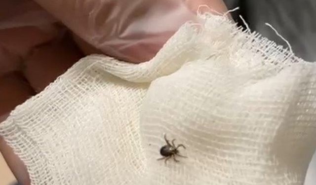 Eskişehir'de 'kene' paniği! Sivilce sandı kene çıktı...